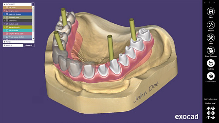 Exocad Implant module - имплант модуль